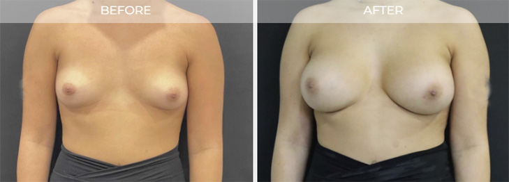 Breast Augmentation Before and After East Brunswick NJ