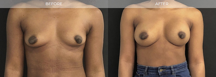 Breast Implants East Brunswick NJ