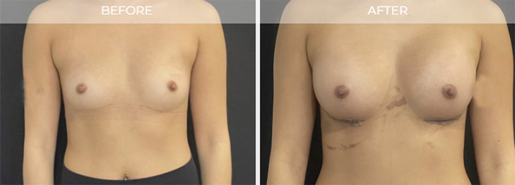 East Brunswick NJ Breast Augmentation Before and After