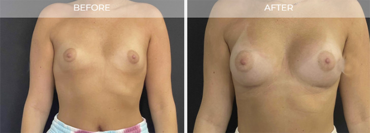 East Brunswick NJ Breast Implants